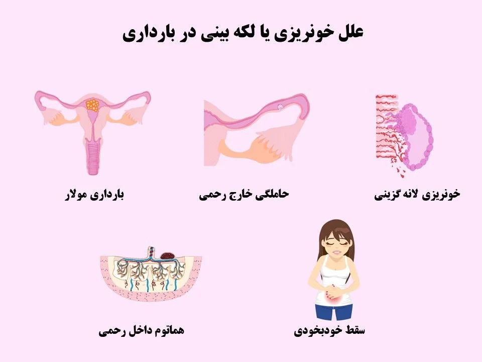 همه چیز در مورد خونریزی یا لکه بینی در بارداری ماه اول تا آخر
