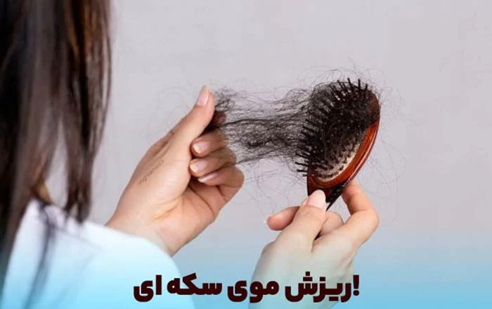 راه درمان ریزش مو سکه ای یا همان آلوپسی چیست؟