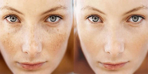 قرص برای از بین بردن لک صورت چی بخوریم؟