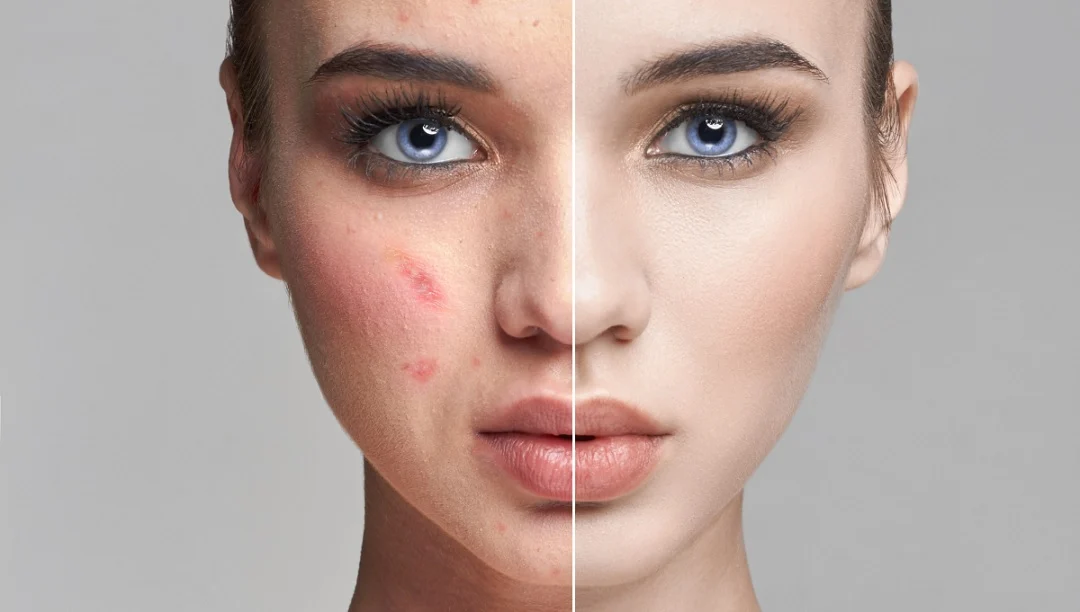 قرص برای از بین بردن لک صورت چی بخوریم؟