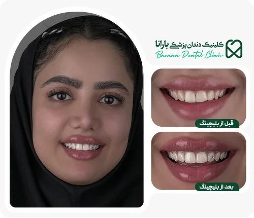 نتیجه بلیچینگ دندان در کلینیک دندانپزشکی بارانا